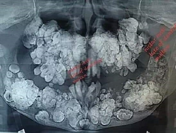 قلع 252 سن من فم مراهق باكستاني يعاني من مرض نادر